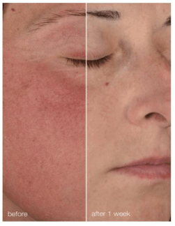 before and after dermalogica ultracalming stabilizing repair cream